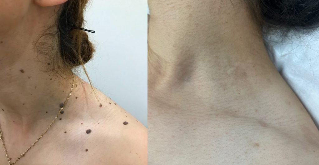 Prima e dopo Verrugel